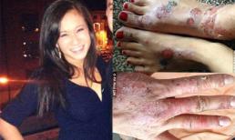 Cô gái gốc Việt bị lở loét toàn thân sau khi độn ngực