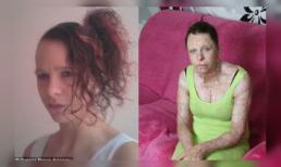 Nỗi đau khủng khiếp của người 'chết' 3 lần trên bàn mổ vì bỏng 