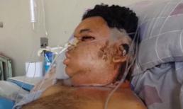 Người đàn ông bị nhện cắn thối tai và mắt khi đang đi vệ sinh