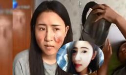 Hot girl Trung Quốc biến dạng mặt vì bị bỏng nước sôi