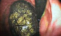 Bối tóc to bằng quả bưởi trong dạ dày em bé 7 tuổi