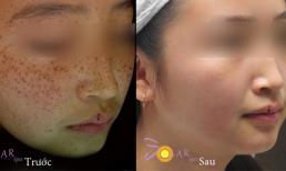 Hot - Ưu đãi 70% dịch vụ trắng da, xóa tàn nhang bằng công nghệ mới