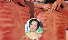 Hình ảnh cạo gió đáng sợ của Thúy Nga