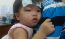 Bé 11 tháng tuổi bị bạn cắn, cào nát mặt khi đi nhà trẻ