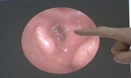 Hàng trăm con giòi bò lúc nhúc trong tai người