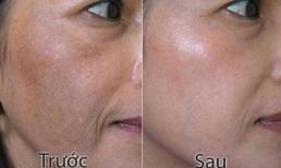 Thanh Hà beauty & Spa áp dụng phương pháp trị nám hiệu quả nhất hiện nay