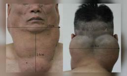 Sở hữu khối u to như cổ ngựa vì uống 2 lít rượu mỗi ngày