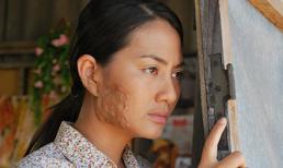 Ngọc Lan bị ‘tai nạn’ bỏng nửa mặt nghiêm trọng