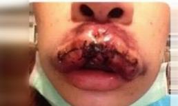 Khiếp sợ với môi dị tật vì phẫu thuật thẩm mỹ hỏng