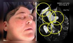 Đầu biến dạng vì bị 5 khối u não hành hạ