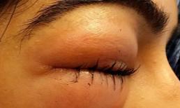 Người phụ nữ bị lồi mắt chỉ sau một lần... xì mũi