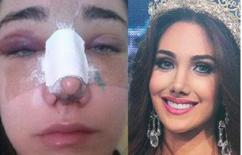 Tân Hoa hậu Quốc tế 2015 lộ ảnh phẫu thuật thẩm mỹ