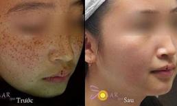 Giải pháp xóa nhanh tàn nhang