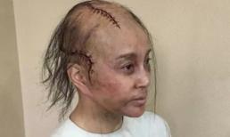 Lưu Hiểu Khánh rụng hết tóc lộ đầu đầy sẹo