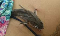 Người phụ nữ bị cá da trơn đâm thẳng gai vào mạng sườn