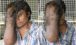 Người đàn ông có khối u trên mặt như vòi voi