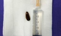 Ăn hạt hướng dương nhiều trẻ nhập viện dịp Tết 