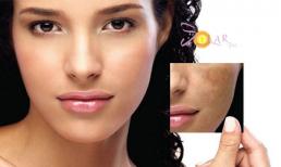 Giải pháp mới xóa nhanh tàn nhang và nám da
