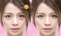 Xóa nhăn - Đánh tan bọng mỡ mắt trong 60 phút không phẫu thuật