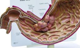 Có triệu chứng này nghĩ ngay đến ung thư dạ dày