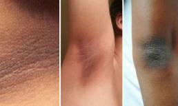 Loại bỏ vùng da khô và tối màu trên cơ thể bằng những cách tự nhiên