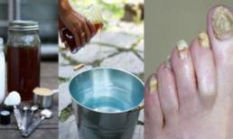 Chữa khỏi nấm móng chân, tay cực đơn giản với giấm táo và baking soda