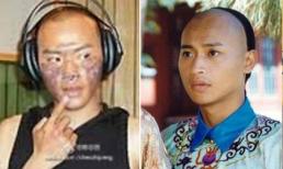 Sao 'Hoàn Châu cách cách' biến dạng gương mặt vì bỏng nặng