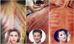 Hình ảnh cạo gió đáng sợ của sao Việt can đảm lắm mới dám nhìn