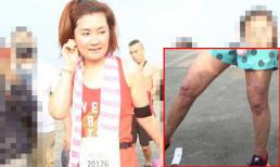 Selina lần đầu không đi tất để lộ chân đầy sẹo