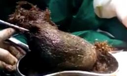 Thiếu niên nuốt búi tóc gần 1kg trong dạ dày