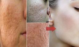 Giảm đáng kể lỗ chân lông to với phương pháp tự nhiên