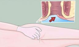 Những dấu hiệu cảnh báo sớm của bệnh ung thư hậu môn 