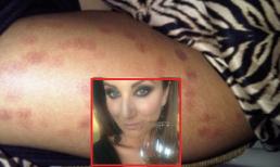 Những vết sẹo đáng sợ trên chân sau khi tẩy lông bằng tia laser