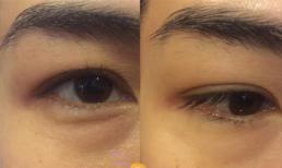 Giảm giá sốc 76% - Phiên bản mới đánh tan bọng mỡ mắt trong 60 phút