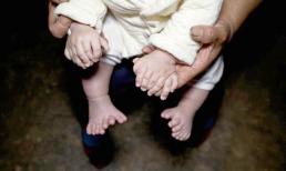 Em bé sinh ra bị dị tật với 15 ngón tay và 16 ngón chân