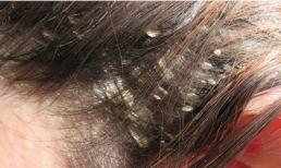 Làm thế nào để chữa trị gàu mãn tính?