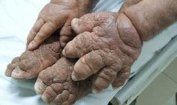 Những bức ảnh về chân và tay người dị dạng đáng sợ