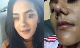Mũi dị dạng vì phẫu thuật thẩm mỹ hỏng