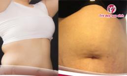 Giảm mỡ bụng cấp tốc đón hè sang nhờ quấn muối Đông Y