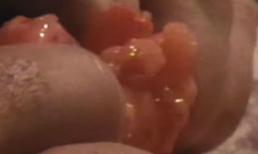 Kinh hãi người đàn ông tự nặn khối u dưới da to như quả bóng