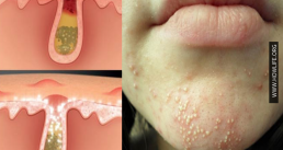 8 cách thoát khỏi mụn trên cằm