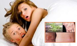 Nổi mảng mụn, u cục vì ham 'vụng trộm bên ngoài'