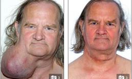 Loại bỏ khối u nặng 1,2 kg sau 25 năm