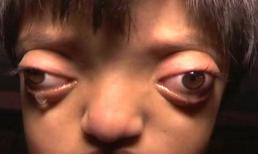 Bé gái có đôi 'mắt ếch' bị nhiều người kỳ thị