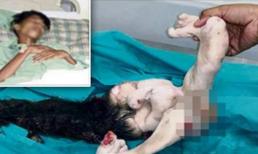 Phát hiện 'thai nhi' trong bụng bé trai 15 tuổi