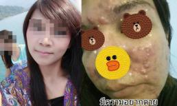 Mua phải kem bôi mặt rởm, cô gái phải chịu hậu quả nặng nề