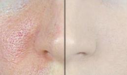 Thu hẹp lỗ chân lông to cho da nhờn chỉ với 2-3 lần thực hiện