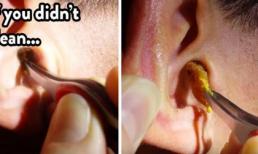 Mẹo loại bỏ ráy tai dễ dàng tại nhà