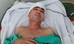 Diễn viên Nguyễn Hoàng ghép hộp sọ thành công