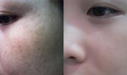 6 bước đơn giản trị hết nám da và tàn nhang đến 85% trong 30 ngày